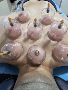 Miracles of Hijama Cupping Therapy Dublin